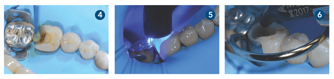 Caso clínico 3M Filtek One Bulk Fill Restorative