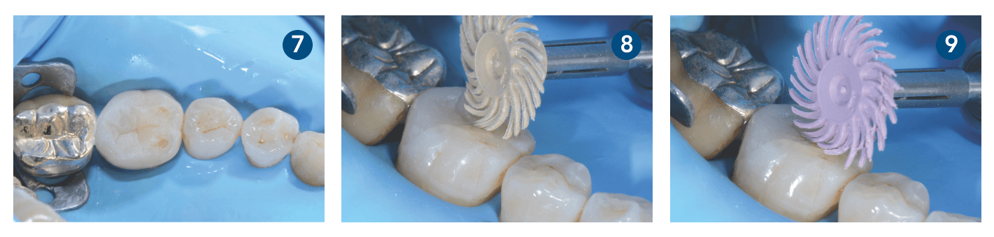 Caso clínico 3M Filtek One Bulk Fill Restorative