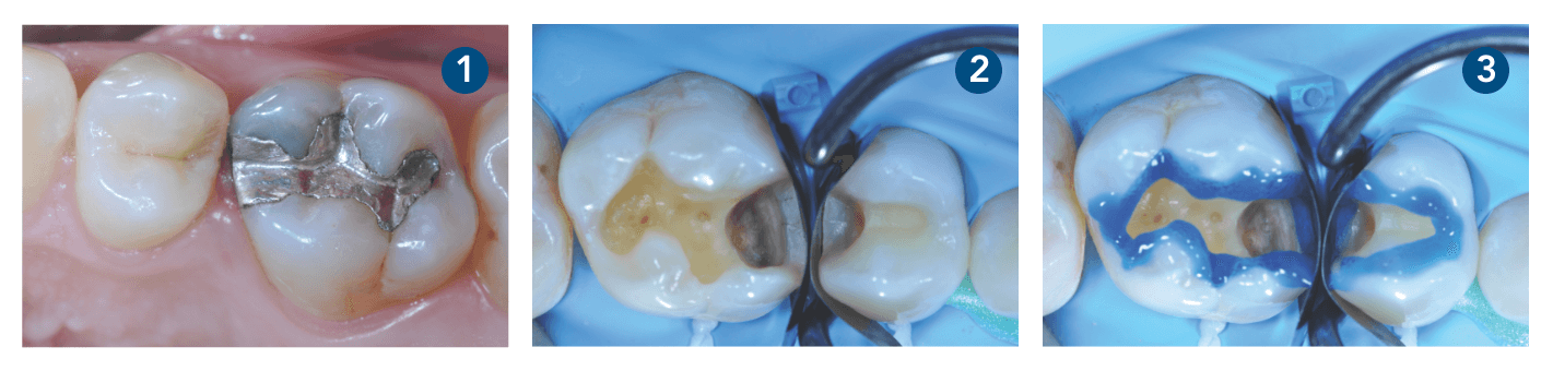 Caso clínico 3M Filtek One Bulk Fill Restorative