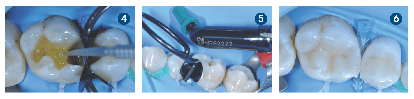 Caso clínico 3M Filtek One Bulk Fill Restorative