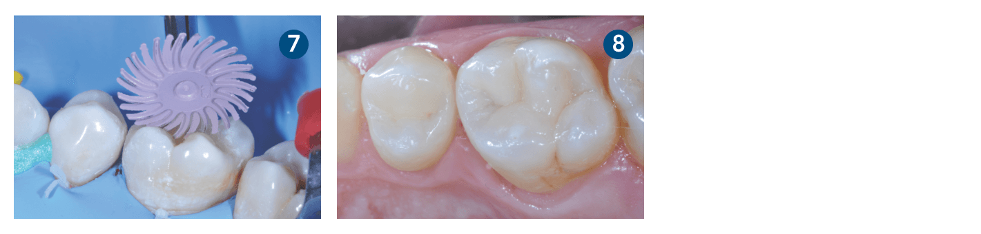 Caso clínico 3M Filtek One Bulk Fill Restorative