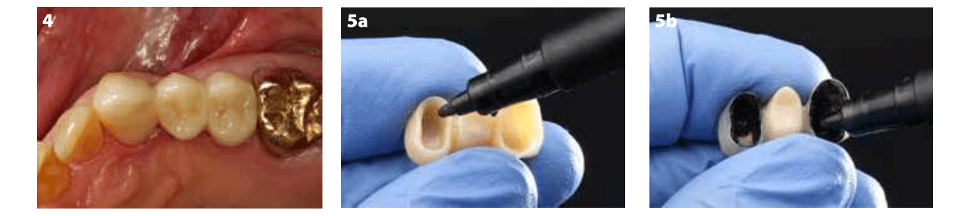  Cimentation de pont monolithique en oxyde de zirconium avec G Cem One 