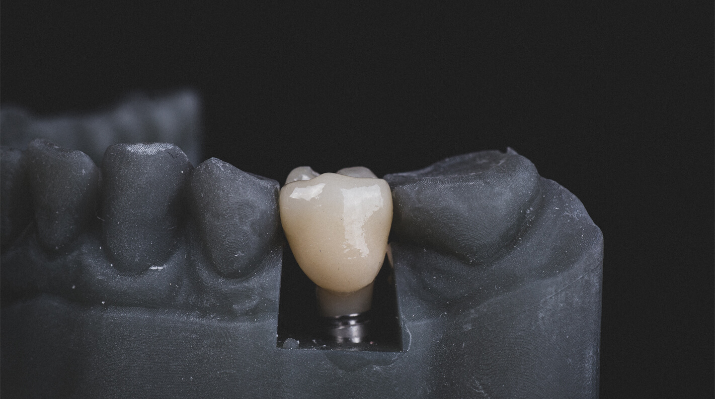 Implantes dentales para la clínica dental