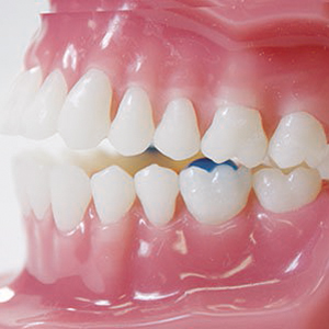 T cnicas De Levante De Mordida En Tratamientos De Ortodoncia Dentaltix T cnicas De Levante De Mordida En Tratamientos De Ortodoncia Dentaltix