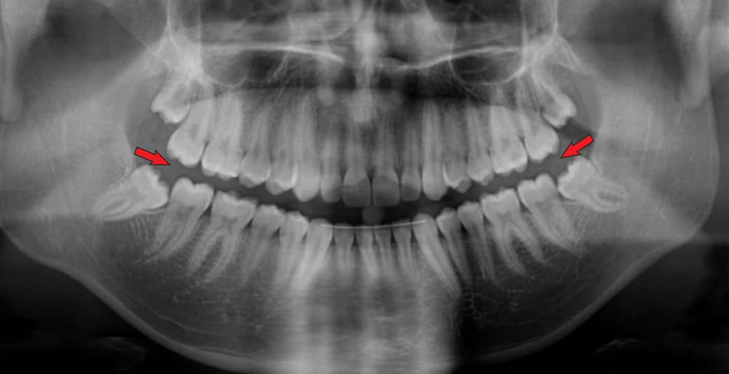 Línea de sonrisa exagerada o como un pico de pájaro