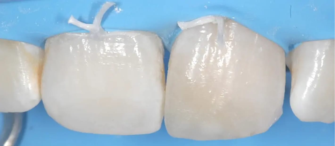Modelado y pulido de la superficie de un diente restaurado con composite