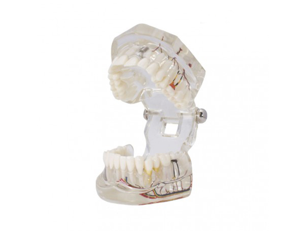 Modelo implante con nervio de Bader