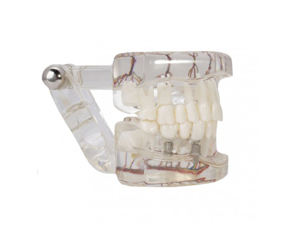 Modelo implante con nervio de Bader