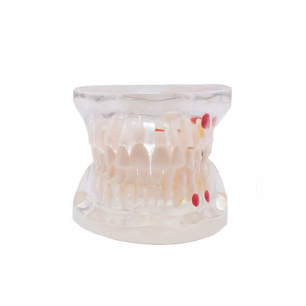 modelo-dental-transparente-caries