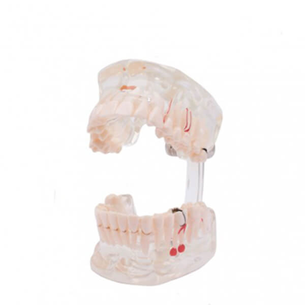 modelo-dental-transparente-implante-2