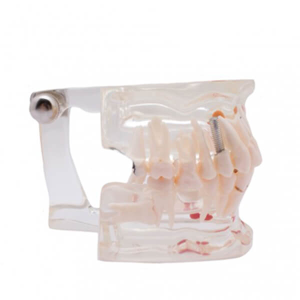 modelo-dental-transparente-implante-3