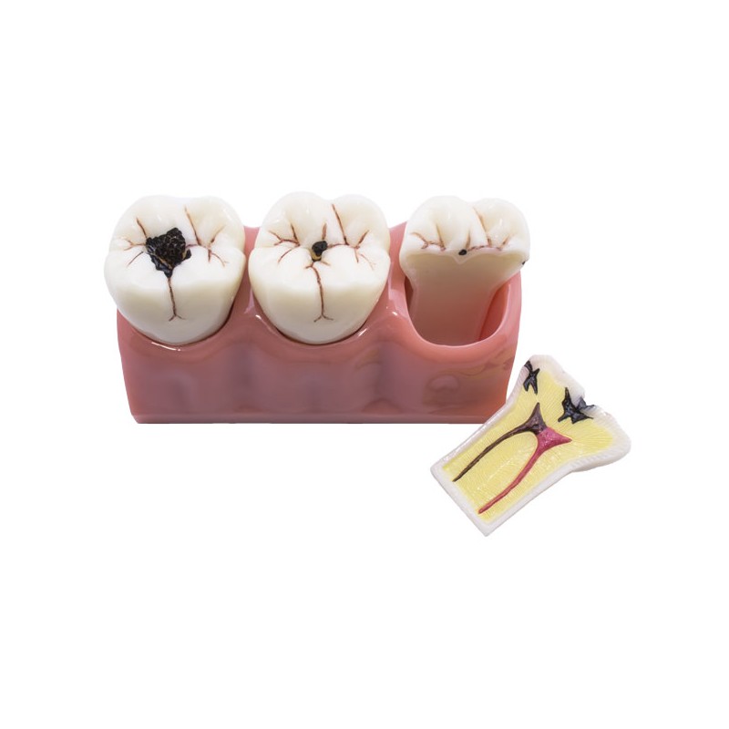 MODELO DESMONTABLE CARIES BADER