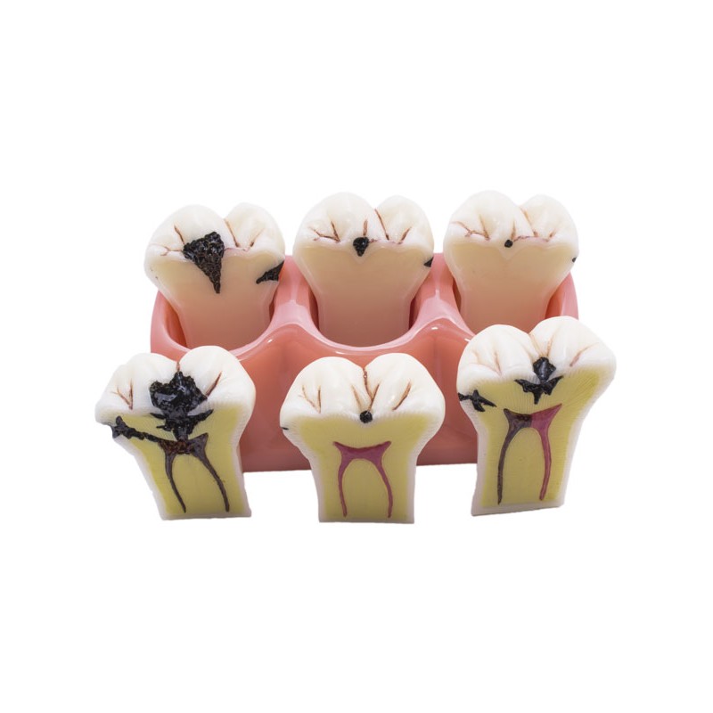 MODELO DESMONTABLE CARIES BADER