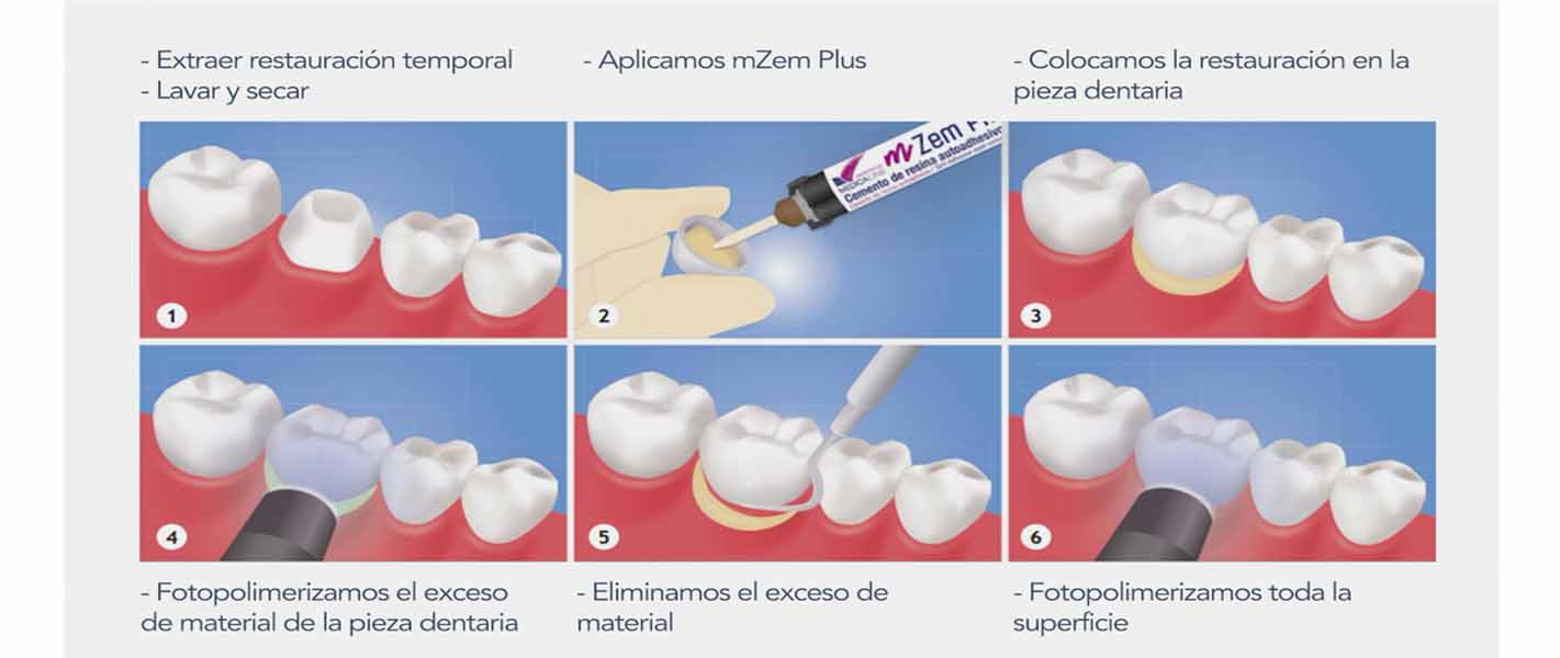 Application du Ciment de Résine Dentaire mZem Plus