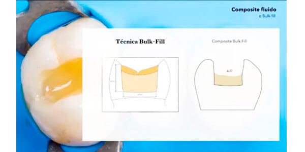 Composite fluido técnica bulk fill