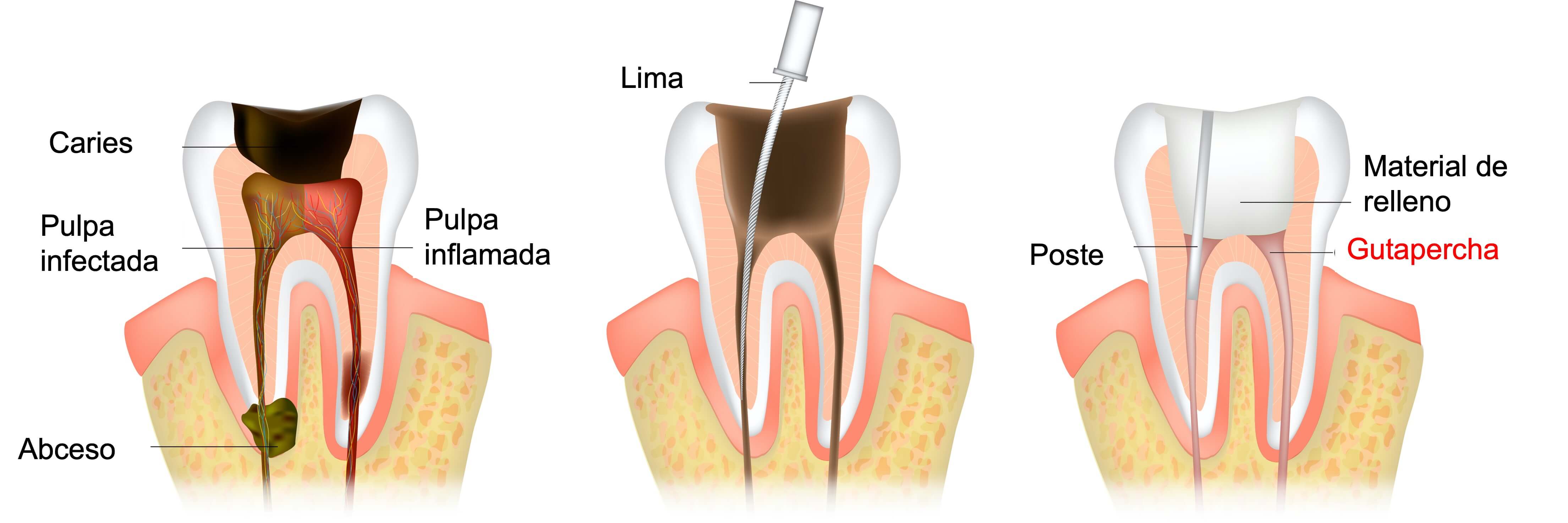 La Guía Definitiva para Gutapercha Dental