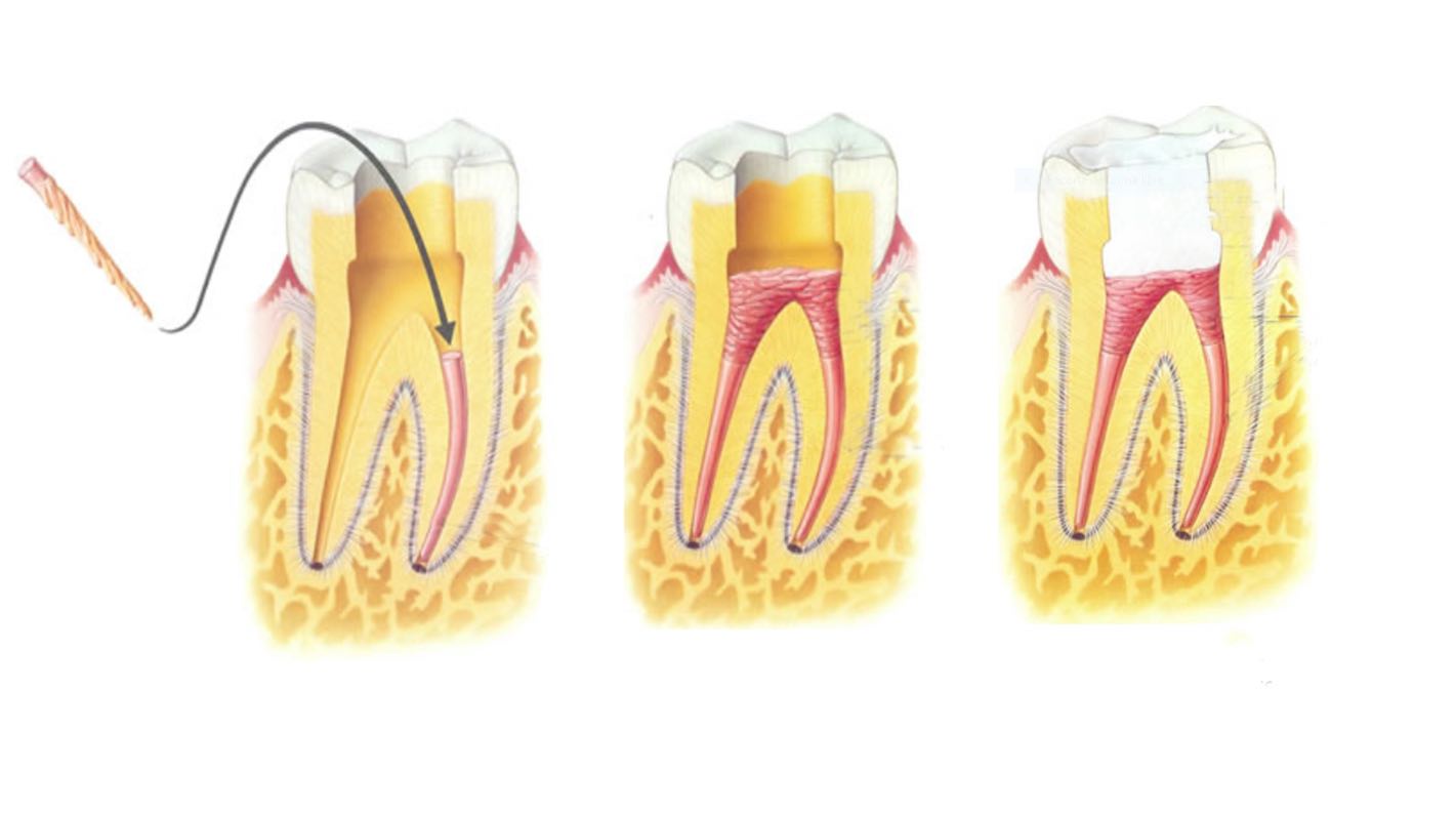 puntas de gutapercha en tratamientos de endodoncia