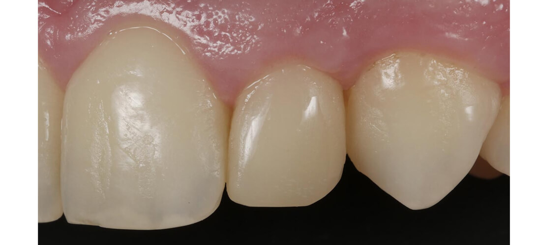 casos clínicos restauracion lateral clavija