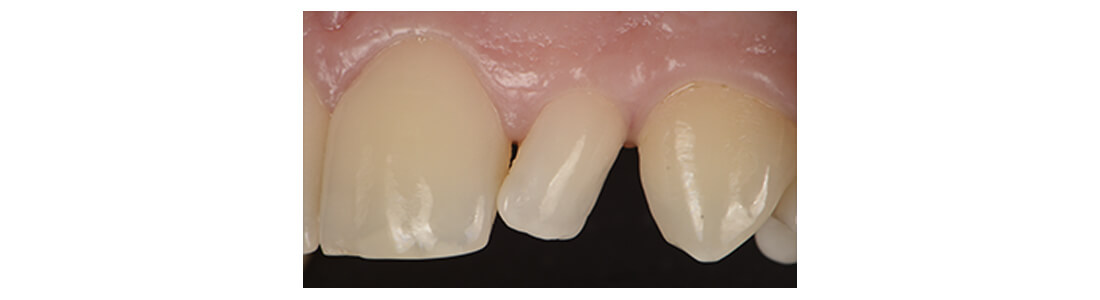 casos clínicos restauracion lateral clavija