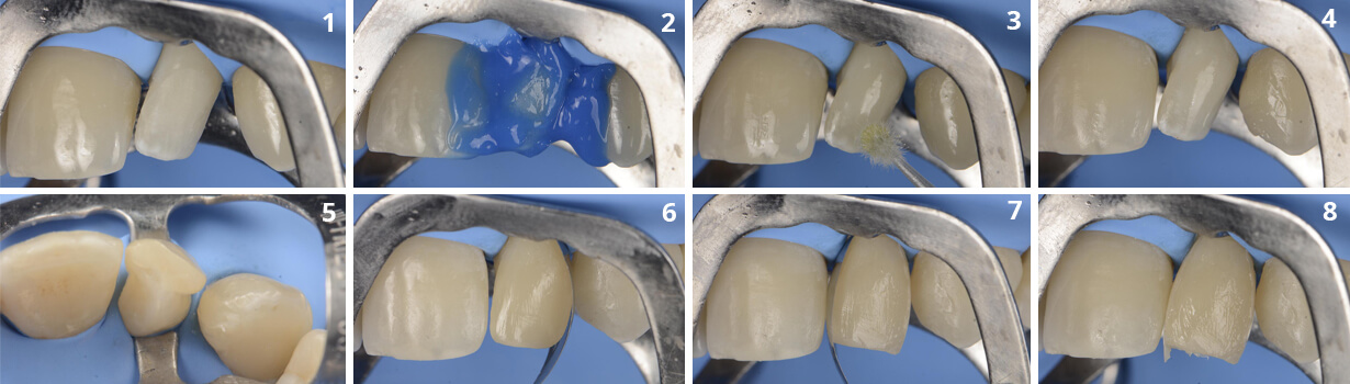 casos clínicos restauracion lateral clavija