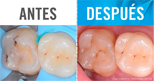 Reparación clase I con composite Venus ONE Shade