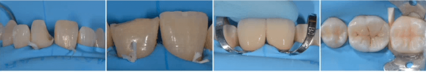 Discoloraciones dentarias