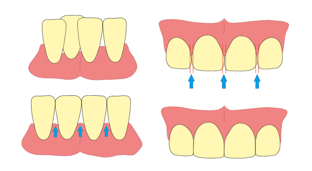 tratamiento stripping dental