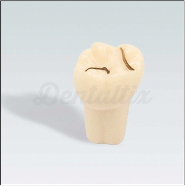 Diente Nº16 con Caries de Fisura Maxilar para Tipodonto Img: 202606271