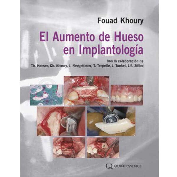 Aumento de Hueso en Implantología - Fouad Khoury Img: 202107311