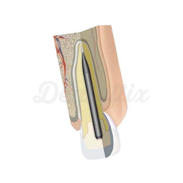 Mirafit® Carbon post L2 Ø 1.20 mm Content: 6 pcs Img: 202207091