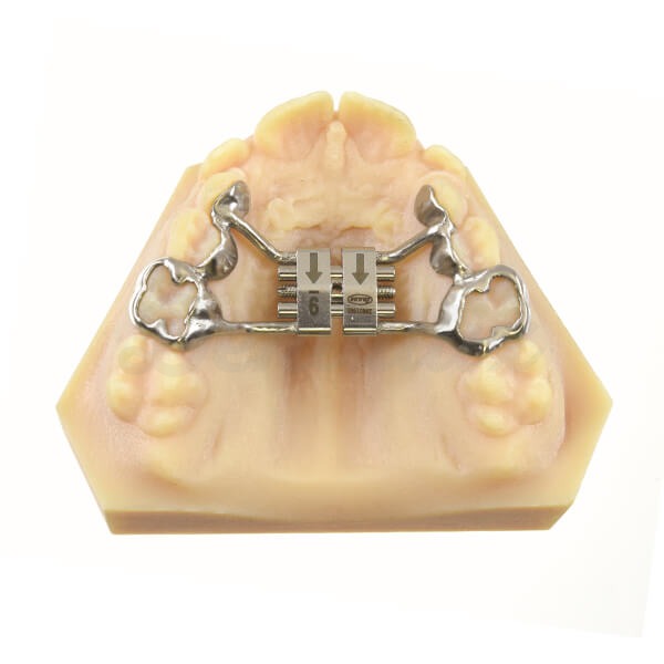 Tornillo Expansor Rápido CAD-CAM Tooth Borne - 14 mm Img: 202403091