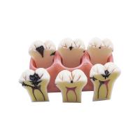 MODELO DESMONTABLE CARIES BADER Img: 202007181 MODELO DESMONTABLE CARIES BADER