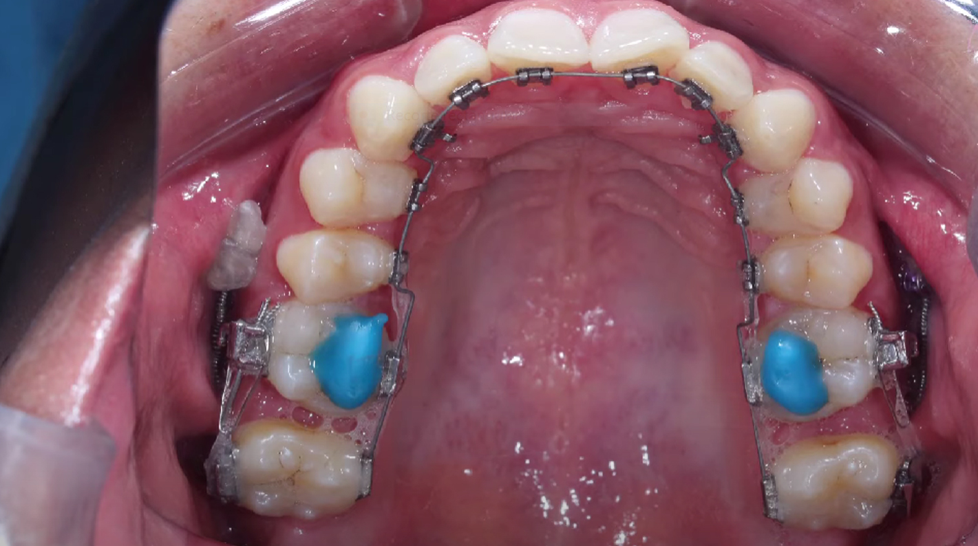 Levée d'occlusion en traitements d'orthodontie