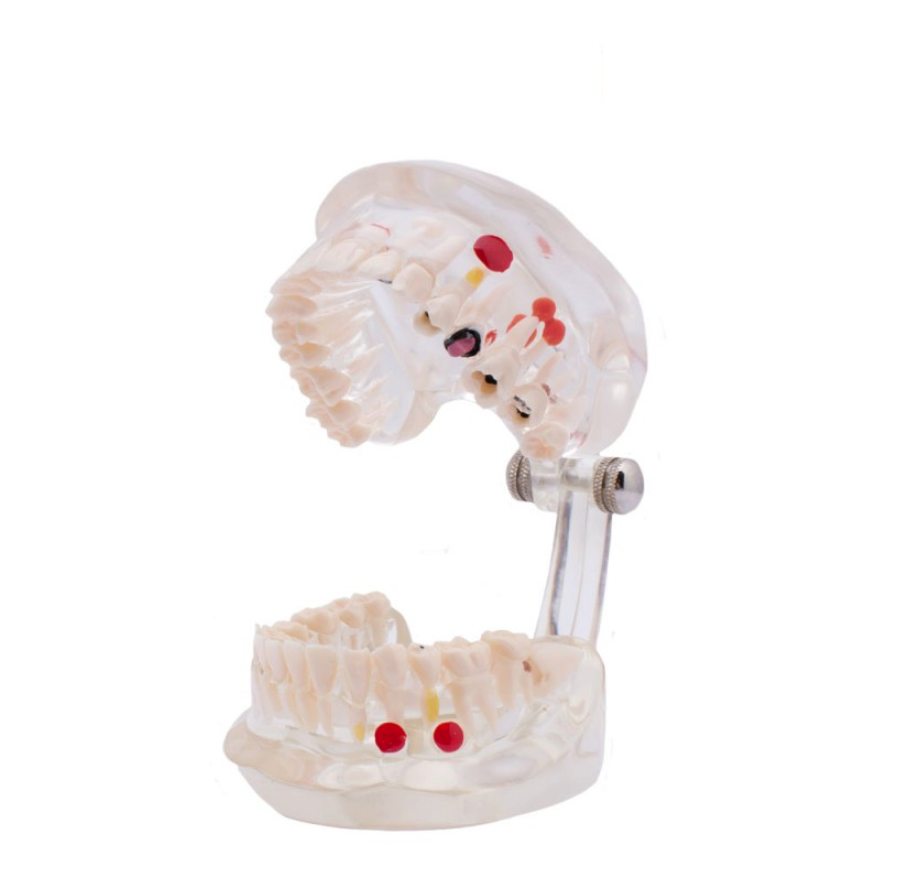 Tipodonto demostrativo Caries Img: 201807031