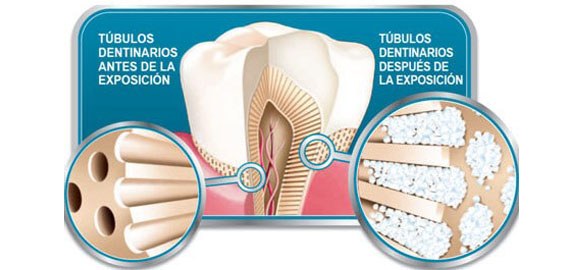 desensibilizantes dentales
