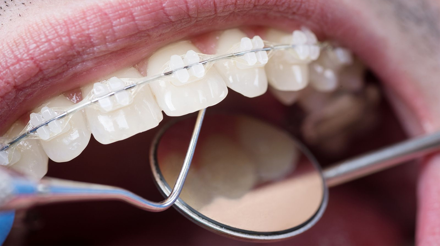 Yongse Dents dentaires Malocclusion Modèle Orthodontique avec Plein Métal Supports Hoops Hoops Dentist Enseignement 