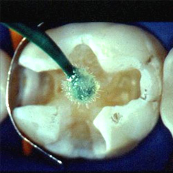 Adhésion sur dentine sèche