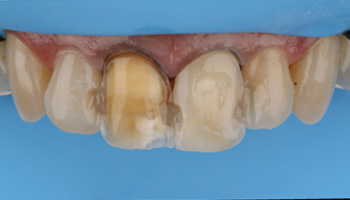 Usage Filtek universal