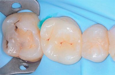 Caries secondaires sur les pièces 25 et 27 Cas clinique 1