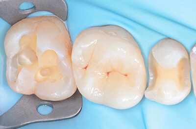 Caries secondaires sur les pièces 25 et 27 Cas clinique 2