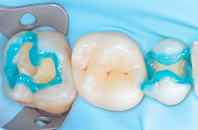 Caries secondaires sur les pièces 25 et 27 Cas clinique 3