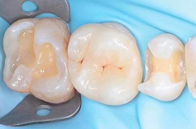 Caries secondaires sur les pièces 25 et 27 Cas clinique 4