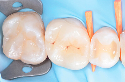 Caries secondaires sur les pièces 25 et 27 Cas clinique 5