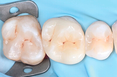 Caries secondaires sur les pièces 25 et 27 Cas clinique 6