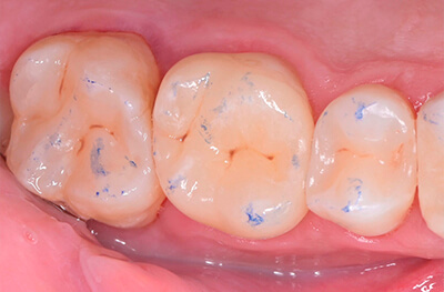 Caries secondaires sur les pièces 25 et 27 Cas clinique 7