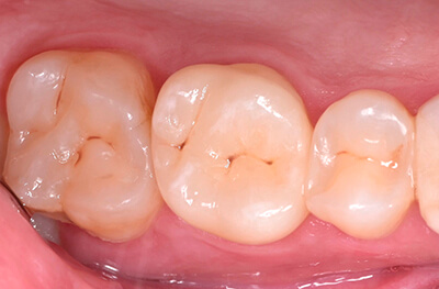 Caries secondaires sur les pièces 25 et 27 Cas clinique 8