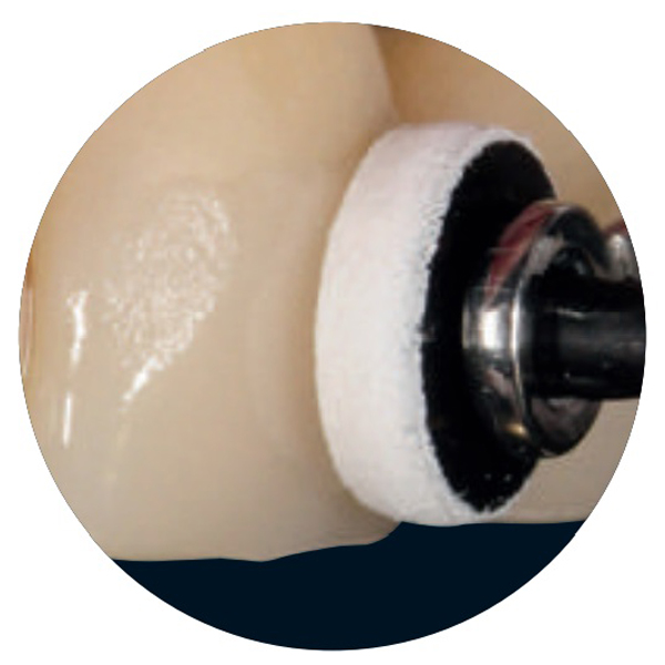 Cas clinique n°4: Réparation intra-orale d'un bridge métallo-céramique