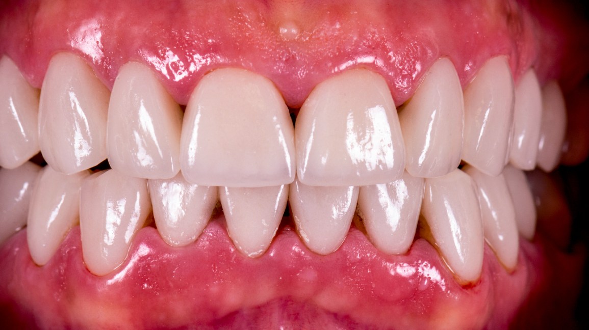 Diastèmes dentaires