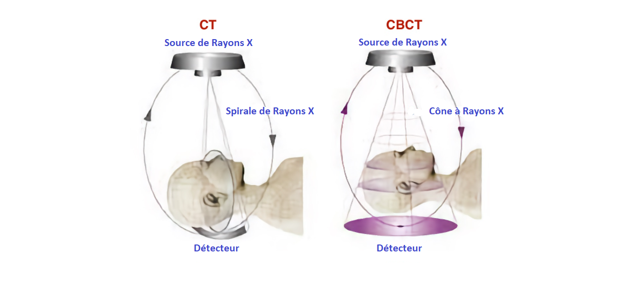 Différences entre CT et CBCT