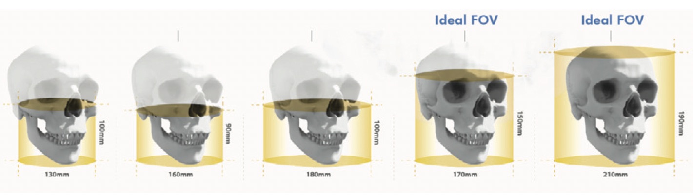 Différents types de FOV dans le CBCT